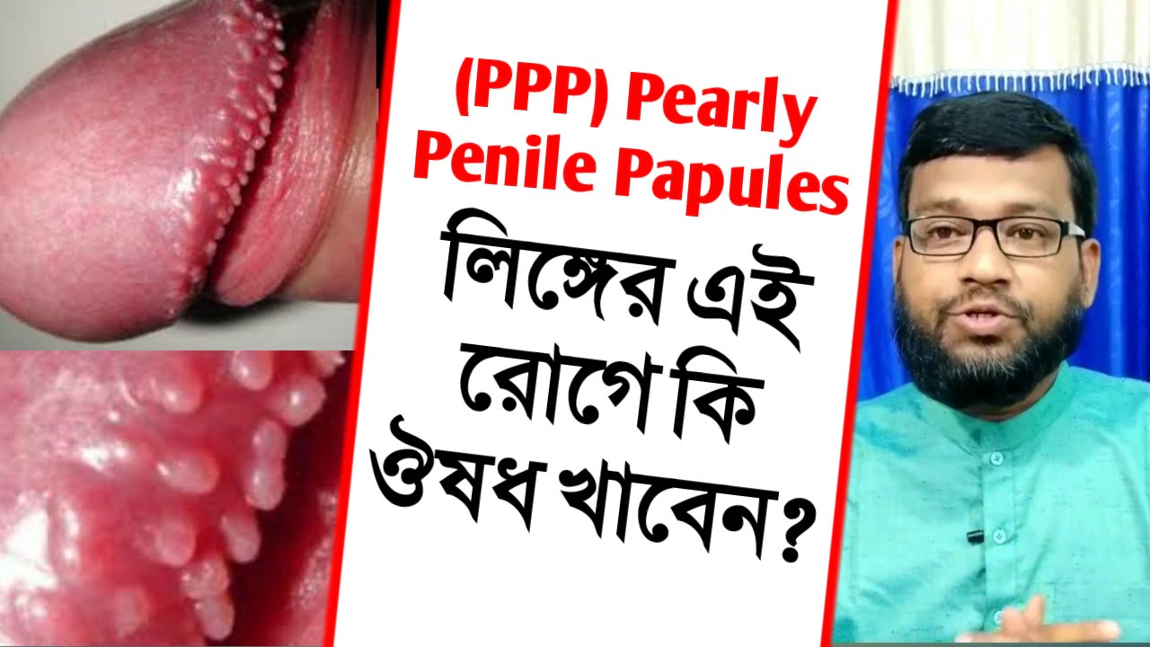 লিঙ্গমুণ্ডে মুক্তাদানা পার্লি পেপলসের হোমিও ঔষধ | (ppp) pearly penile papules homeopathic treatment